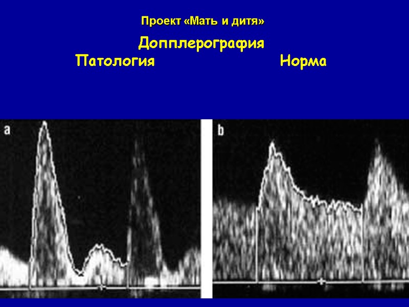 Допплерография Патология    Норма